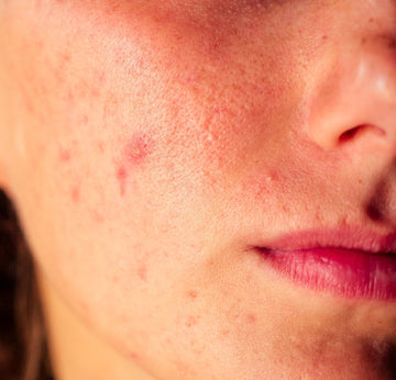 Acne Under Control: Your Step-by-Step Skincare Routine for Acne-Prone Skin