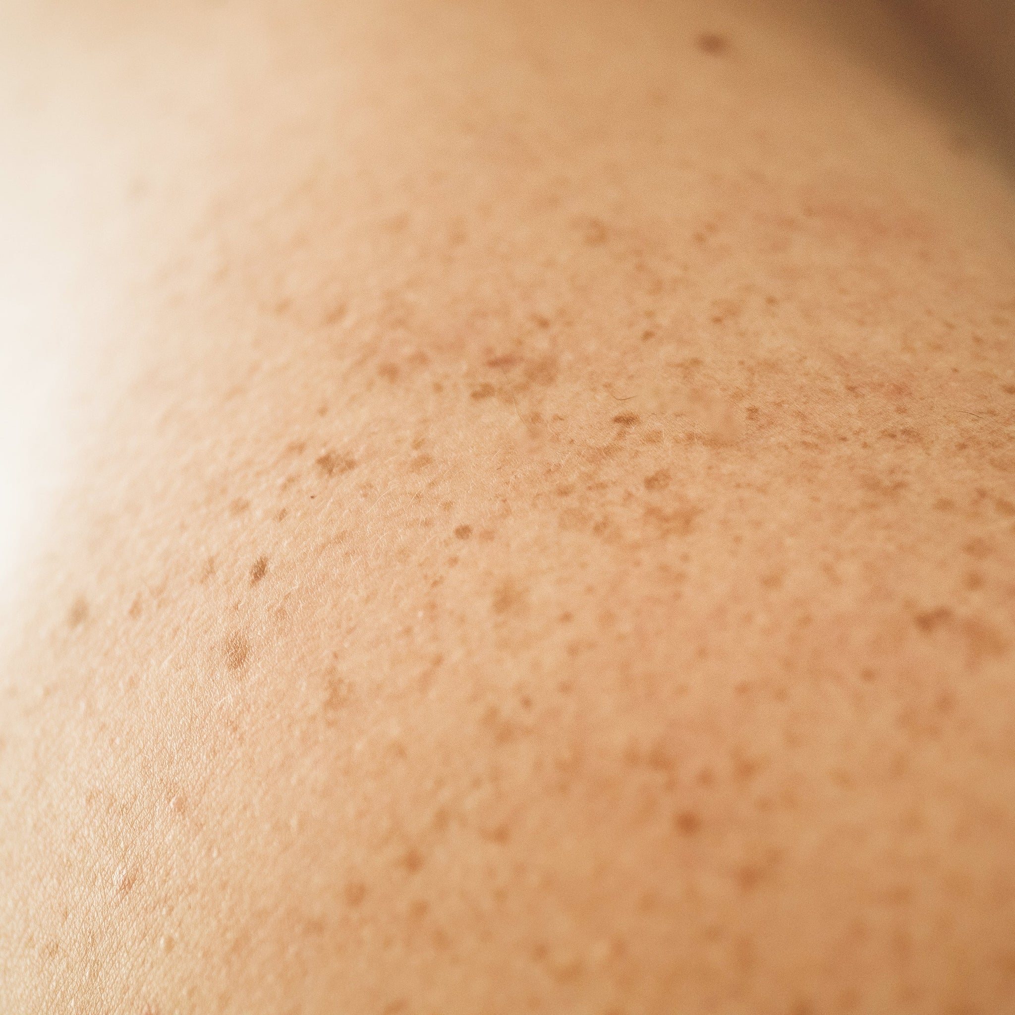 Dark Spots No More: Understanding and Preventing Hyperpigmentation ...